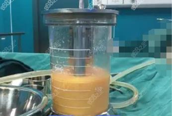建湖360度水动力吸脂费用多少钱？