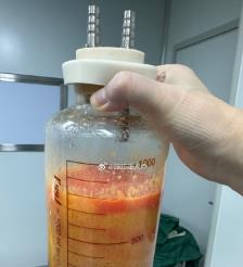 建湖水动力吸脂手术要做多久？